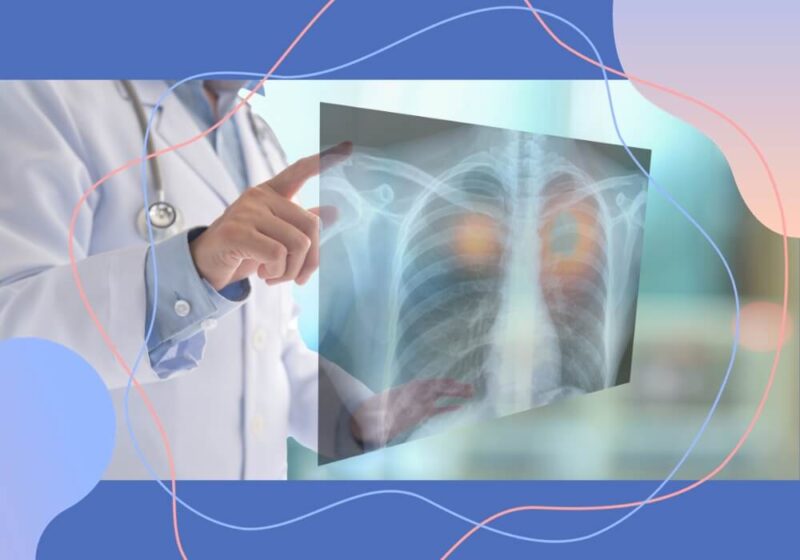 Graphic of doctor looking at xray to detect lung cancer.